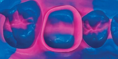 Polyether Impression Materials

