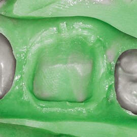Unclear margins in dental molds