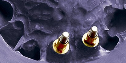 VPS Alginate Alternative Impression Materials
