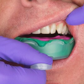 Distortions during impression removal
