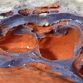 Distortions due to delamination of impression tray
