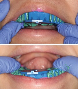 Tray placement for dental impression