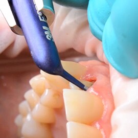 Controlling bleeding with Retraction Capsule